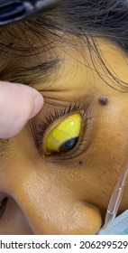 The Yellow Eye In A Young Lady Who Has Acute Liver Failure From Herbal Medicine.