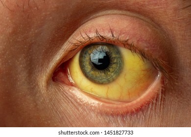 Yellow Eyes Liver Images Stock Photos Vectors Shutterstock
