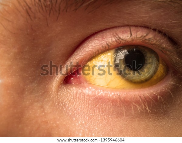 yellow staining of the\
sclera of the eye in diseases of the liver, cirrhosis, hepatitis,\
bilirubin