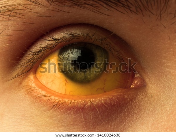 yellow staining of the
sclera of the eye in diseases of the liver, cirrhosis, hepatitis,
bilirubin