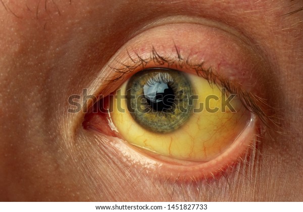 yellow staining of the\
sclera of the eye in diseases of the liver, cirrhosis, hepatitis,\
bilirubin