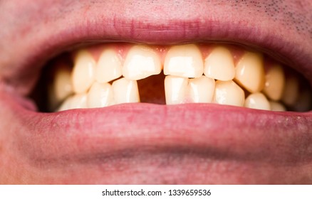 Yellow Teeth. Bad Dental Health, No Teeth, No Fluoride, Tooth Erosion. Yellow Bad Teeth. Man Without One Front Tooth. No Teeth. Smile Men With A Lost Front Tooth, Toothache. 