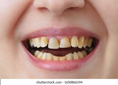 Yellow teeth of a caucasian woman before treatment and whitening of teeth, dental crowns. Dentistry Close-up.