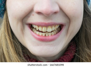 
Yellow teeth of a girl, fluorosis. Smoker's problem teeth caused by fluoride, smoking, or coffee. Brown tooth enamel due to illness and drugs. Light skin and a wide smile. Natural photo