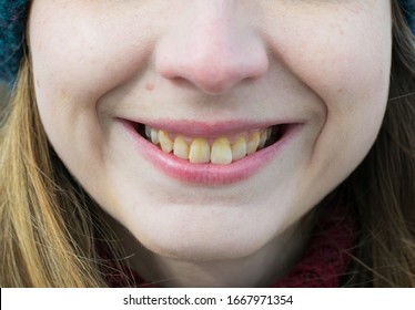 Yellow teeth of a girl, fluorosis. Smoker's problem teeth caused by fluoride, smoking, or coffee. Brown tooth enamel due to illness and drugs. Light skin and a wide smile. Natural photo