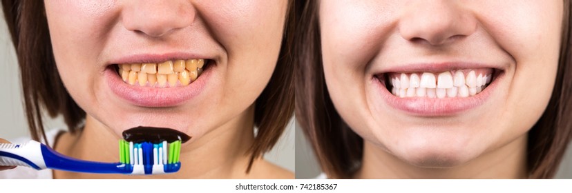 yellow and white teeth before and after