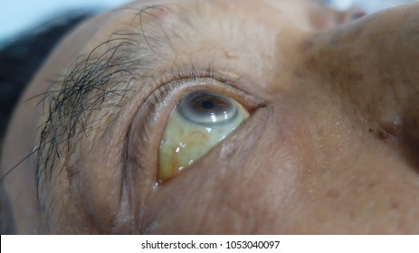 Yellowish Discoloration Of Sclera And Arcus Senilis In Patient With Obstructive Jaundice.