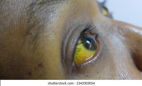 no blue square or scleral icterus