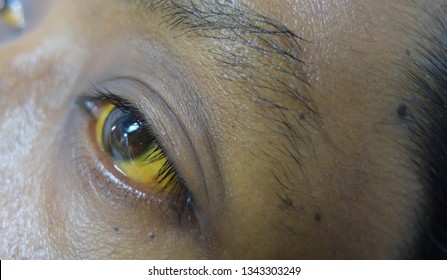 Yellowish Discoloration Of The Sclera Or Jaundice.