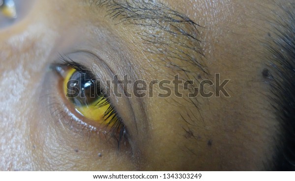 scleral icterus after treatment with trimethoprim