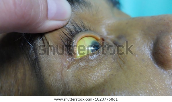 scleral icterus after treatment with trimethoprim