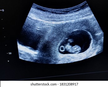 yolk sac amniotic sac fetus 8 weeks by ultrasound scan  - Shutterstock ID 1831208917