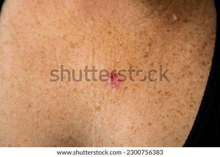 Young 30s caucasian female is anxious aftern superficial basal cell carcinoma skin cancer diagnosis.