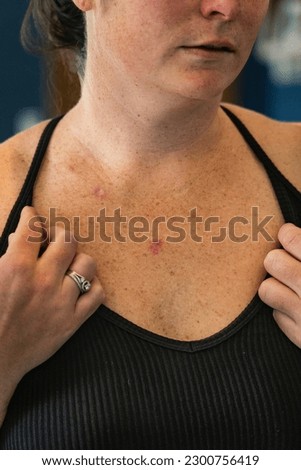 Young 30s caucasian female examines ulcerated open wound of superficial basal cell carcinoma showing red discoloration on her chest.
