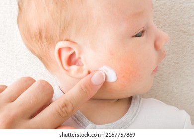 Young Adult Mother Finger Applying White Medical Ointment On Newborn Boy Cheek. Red Rash On Skin. Allergy From Milk Formula Or Mother Milk. Care About Baby Body. Closeup. Top Down View.