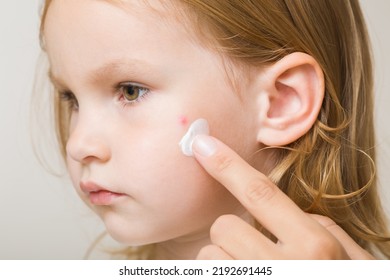 Young Adult Mother Finger Applying White Moisturizing Cream On Toddler Girl Cheek. Red Rash After Bite Of Mosquito. Care About Child Body Skin. Closeup. Side View.