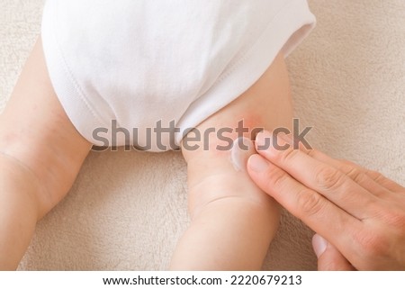 Young adult mother finger applying white medical ointment on newborn bare leg. Red rash on skin. Allergy from milk formula or mother milk. Care about baby body. Closeup. Top view.