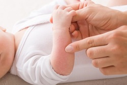 Young Adult Mother Finger Pointing To Newborn Arm With Red Rash. Allergy From Milk Formula Or Mother Milk. Baby Skin Problem. Closeup. Side View.