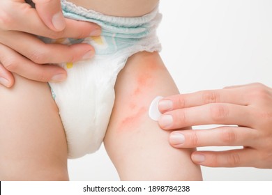 Mano de madre adulta joven aplicando pomada médica blanca en la pierna de niño pequeño. Erupción roja en la piel de pañal. Cuidado con el cuerpo del bebé. Cerrando. Vista frontal. Aislado sobre fondo gris claro.