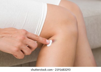 Young Adult Woman Sitting On Sofa. Finger Applying White Medical Ointment On Bruise On Leg Skin. First Aid. Self Help. Closeup.