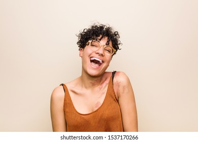 Young African American Woman With Skin Birth Mark Relaxed And Happy Laughing, Neck Stretched Showing Teeth.