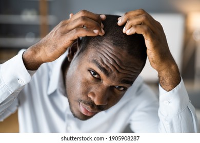 Young African Men Hair Loss. Watching Hairloss