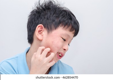 Young Asian Boy Scratching His Allergy Face ,drug Allergy Concept.