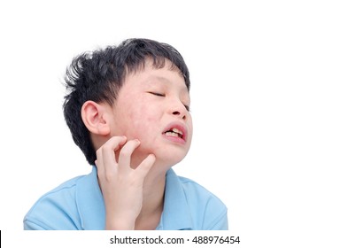 Young Asian Boy Scratching His Allergy Face Over White Background With Copy Space