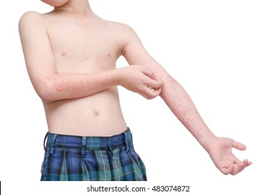 Young Asian Child Scratching Arms Skin With Rash Over White Background
