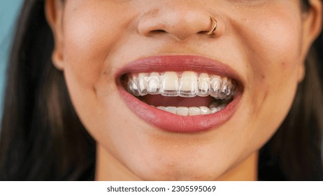Young Asian Indian woman holding removable invisible aligner, also known as invisalign or  clear aligner
