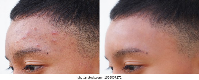 Aging Spots Before After Hd Stock Images Shutterstock