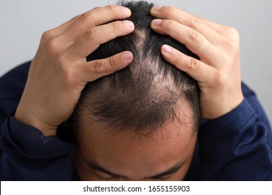 Young Asian Man Having Serious Hair Loss Problem