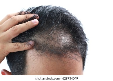 Young Asian man having serious hair loss problem