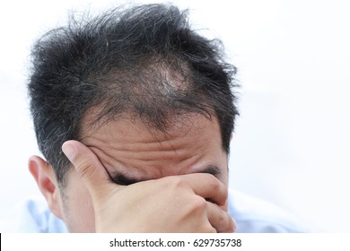 Young Asian Man Having Serious Hair Loss Problem
