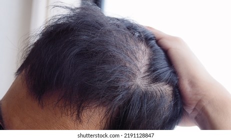 Young Asian Man Using His Hand Slicking His Hair Back After Facing Hair Loss Problem By Taking Medicine Like Zinc And Biotin To Make His Hair Grow Faster And Thicker. Men Health And Medical Concept