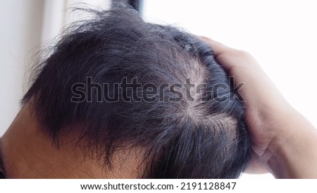 Young Asian man using his hand slicking his hair back after facing hair loss problem by taking medicine like zinc and biotin to make his hair grow faster and thicker Men health and medical concept