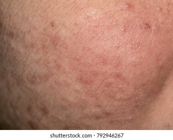 Nodular Acne Images, Stock Photos & Vectors | Shutterstock nodular acne diagram 