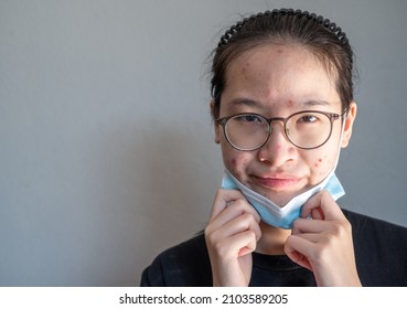 Young Asian Woman Taking Off A Mask For Showing Her Face Having Acne Inflammation. Wearing Mask For A Longtime Can Actually Cause A Variety Of Skin Problems.