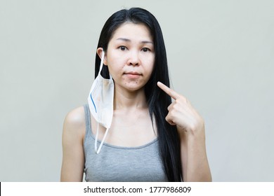 Young Asian Woman Wearing Medical Face Mask  Her Hand Point At Pimple On Chin,Skin Allergy,acne From Wearing A Mask.