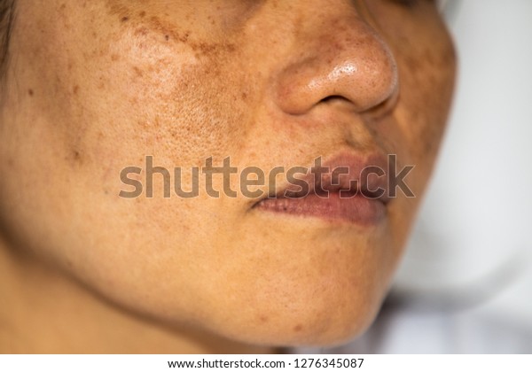 Depigmentation in asian skin