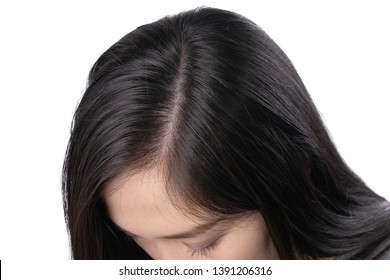 Young Asian Women Worry About Problem Hair Loss,head Bald,dandruff.hair Loss Problem And Hair Treatment Concept