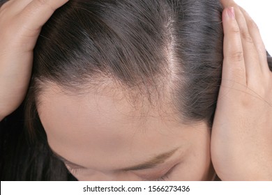 Hair Thinning Woman Images Stock Photos Vectors Shutterstock