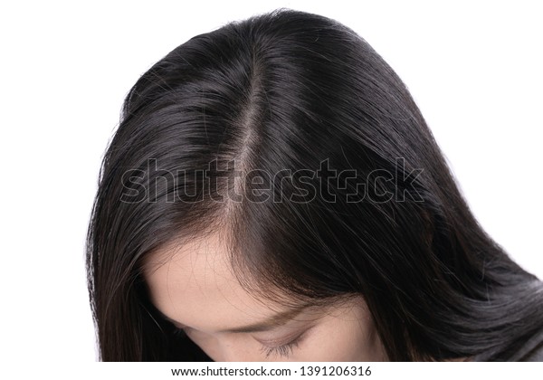 Young Asian women\
worry about problem hair loss,head bald,dandruff.hair loss problem\
and Hair treatment\
concept