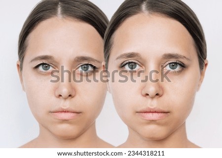 Young attractive caucasian woman's face with drooping upper eyelid before and after blepharoplasty isolated on a white background. The result of plastic surgery. Changing the shape, cut of the eyes
