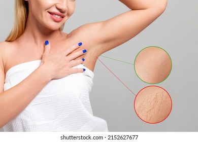 Young beautiful smiling woman showing the smooth skin of her armpits. Enlarged area with results before and after depilation procedures. The concept of photoepilation and laser hair removal - Shutterstock ID 2152627677