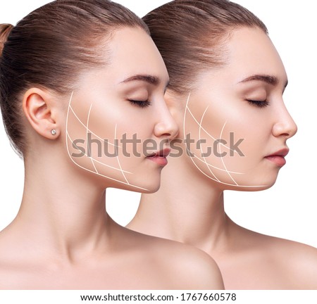 Young beautiful woman with lifting lines before and after chin correction. Over white background.