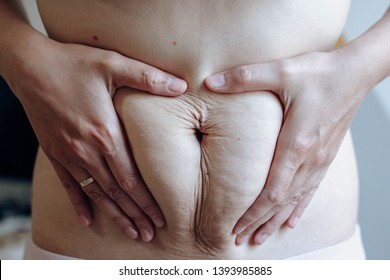 Young Belly But Flabby Postpartum With Wrinkles