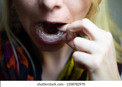 A Young Blonde Woman Wears A Retainer Before Going To Sleep To Ensure That Her Straight Teeth Don't Shift Into A Crooked Position Overnight.