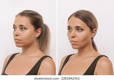 Young blonde woman's face before and after plastic surgery buccal fat pad removal isolated on a white background. A lower part of face with clear highlighted cheekbones. Result of cosmetic surgery