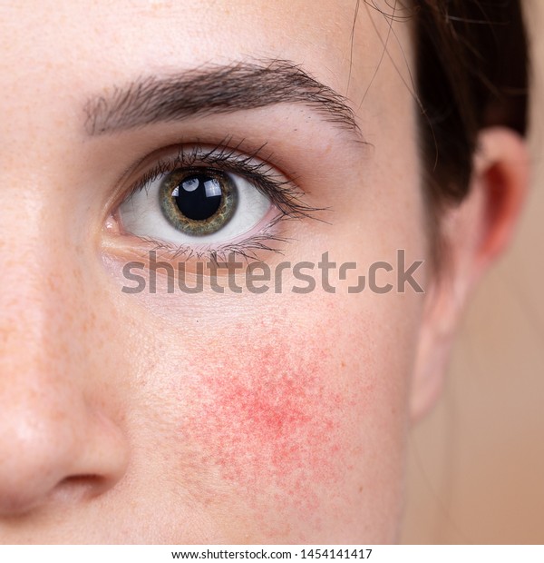 代前半の白人の若い女の子が近くで見られる 緑のアイリスと目の領域の詳細 薔薇のような頬は小さな赤い染みで見える 一般的な皮膚疾患のロサセアの症状 の写真素材 今すぐ編集